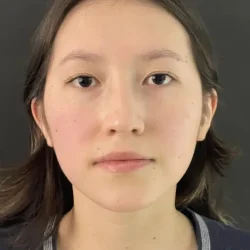 Resultados rinoplastia I Quito2