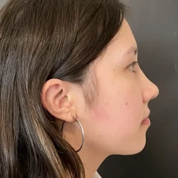 Resultados rinoplastia I Quito3
