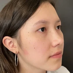 Resultados rinoplastia I Quito5