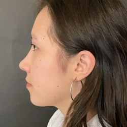 Resultados rinoplastia I Quito7