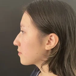 Resultados rinoplastia I Quito8