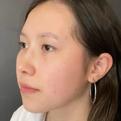 Resultados rinoplastia I Quito9