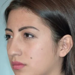 Resultados rinoplastia J Quito10