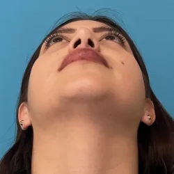 Resultados rinoplastia J Quito11