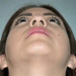 Resultados rinoplastia J Quito12
