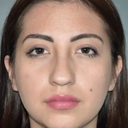 Resultados rinoplastia J Quito2