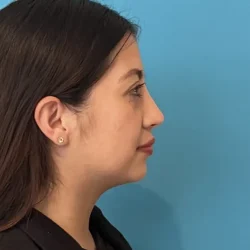 Resultados rinoplastia J Quito3