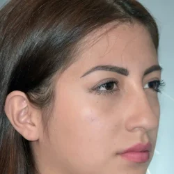 Resultados rinoplastia J Quito6