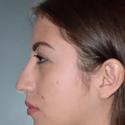 Resultados rinoplastia J Quito8
