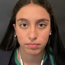 Resultados rinoplastia K Quito1