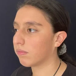 Resultados rinoplastia K Quito10