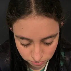 Resultados rinoplastia K Quito13