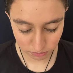 Resultados rinoplastia K Quito14