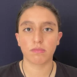Resultados rinoplastia K Quito2