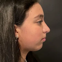 Resultados rinoplastia K Quito3