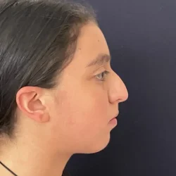Resultados rinoplastia K Quito4