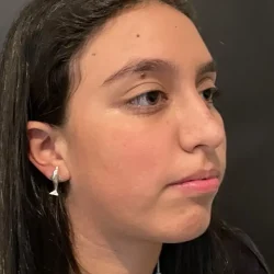 Resultados rinoplastia K Quito5
