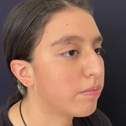 Resultados rinoplastia K Quito6
