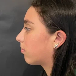 Resultados rinoplastia K Quito7