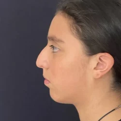 Resultados rinoplastia K Quito8