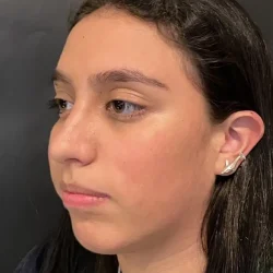 Resultados rinoplastia K Quito9