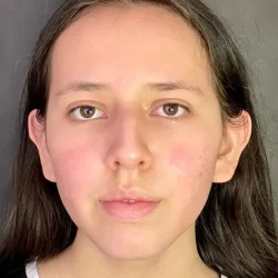 Resultados rinoplastia L Quito1