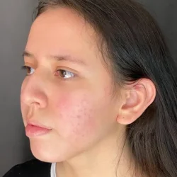 Resultados rinoplastia L Quito10