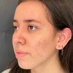 Resultados rinoplastia L Quito12