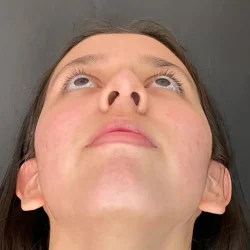 Resultados rinoplastia L Quito13