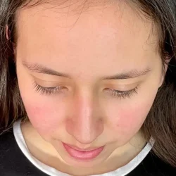 Resultados rinoplastia L Quito15