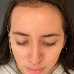 Resultados rinoplastia L Quito16