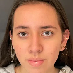 Resultados rinoplastia L Quito2