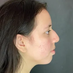Resultados rinoplastia L Quito3