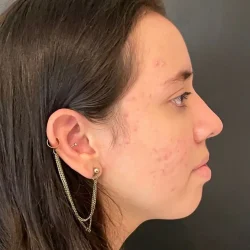 Resultados rinoplastia L Quito4