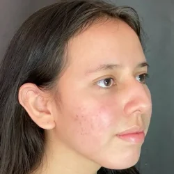 Resultados rinoplastia L Quito5