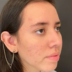 Resultados rinoplastia L Quito6