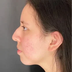 Resultados rinoplastia L Quito7