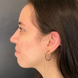 Resultados rinoplastia L Quito8