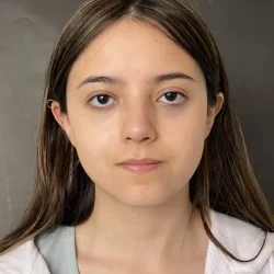 Resultados rinoplastia M Quito1