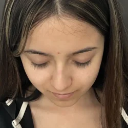 Resultados rinoplastia M Quito12