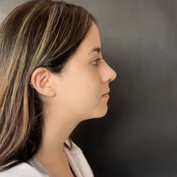 Resultados rinoplastia M Quito3