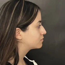 Resultados rinoplastia M Quito4