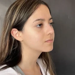 Resultados rinoplastia M Quito5