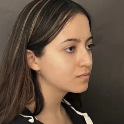Resultados rinoplastia M Quito6