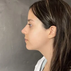Resultados rinoplastia M Quito7