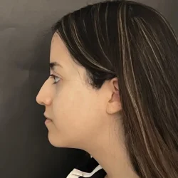 Resultados rinoplastia M Quito8