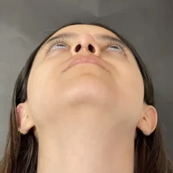 Resultados rinoplastia M Quito9
