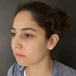 Resultados rinoplastia N Quito10