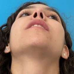 Resultados rinoplastia N Quito11