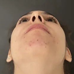 Resultados rinoplastia N Quito12
